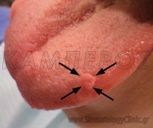 Θήλωμα στόματος